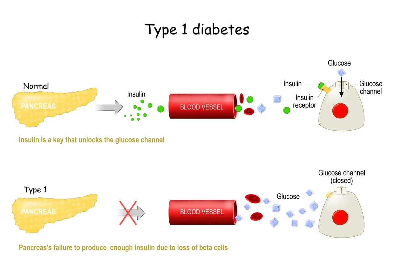 Typen von Diabetes mellitus.