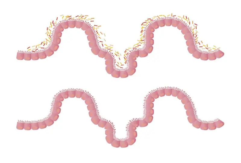 Stuhltransplantation (FMT)