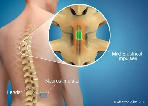 Epidurale Stimulation Stammzellbehandlung
