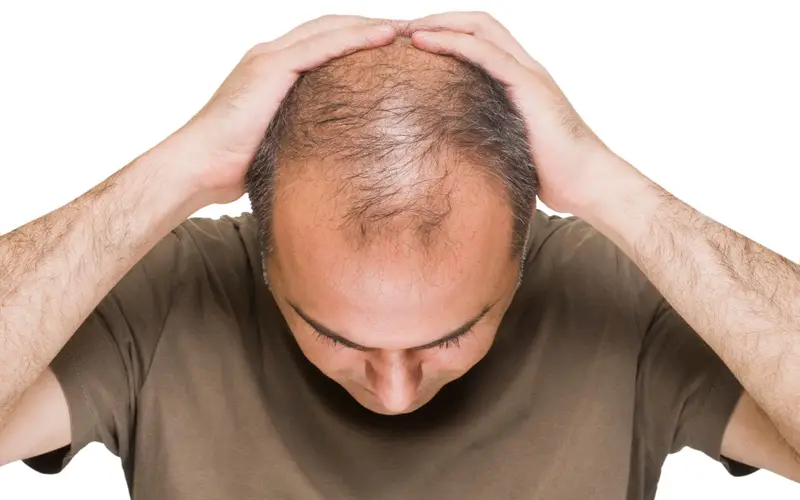 Das Potenzial der Stammzelltherapie bei Haarausfall