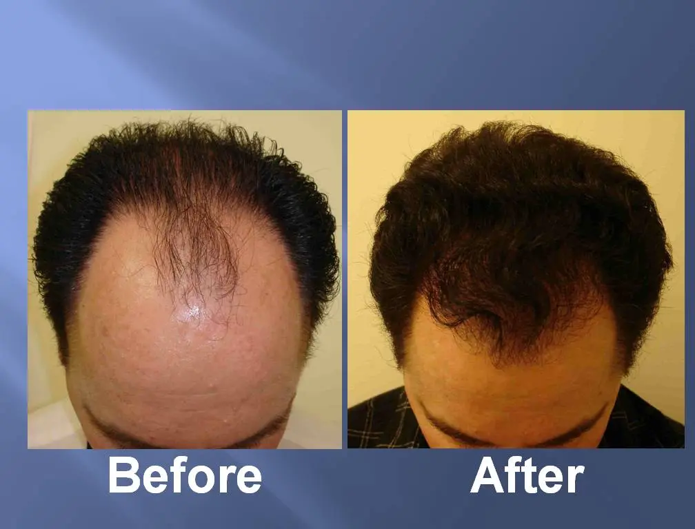 Vorher-Nachher-Bilder der Haarwiederherstellung mittels Stammzelltherapie